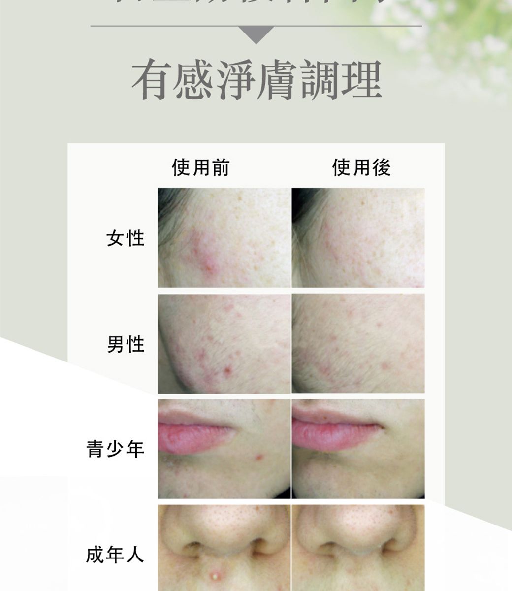 有感淨膚調理女性男性青少年成年人使用前使用後