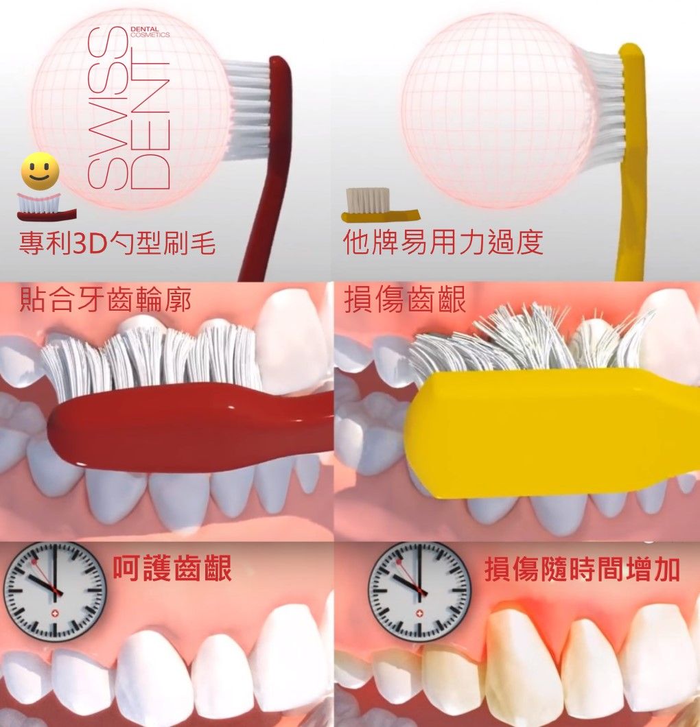 SWISSDENTALCOSMETICSDENT專利3D勺型刷毛他牌易用力過度貼合牙齒輪廓損傷齒齦呵護齒齦損傷隨時間增加