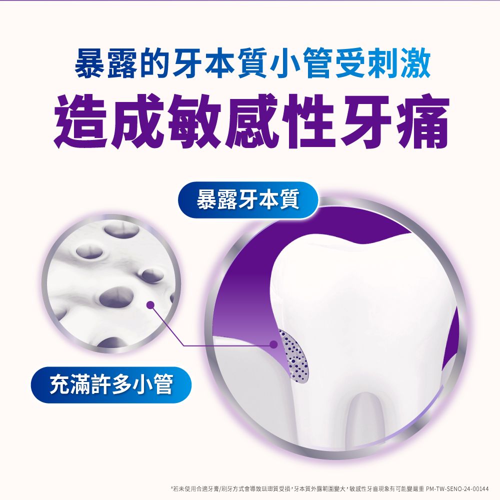 暴露的牙本質小管受刺激造成敏感性牙痛暴露牙本質充滿許多小管*若未使用合適牙膏/刷牙方式會導致琺瑯質受損,牙本質外露範圍變大,敏感性牙齒現象有可能變嚴重 PM-TW-SENO-24-00144