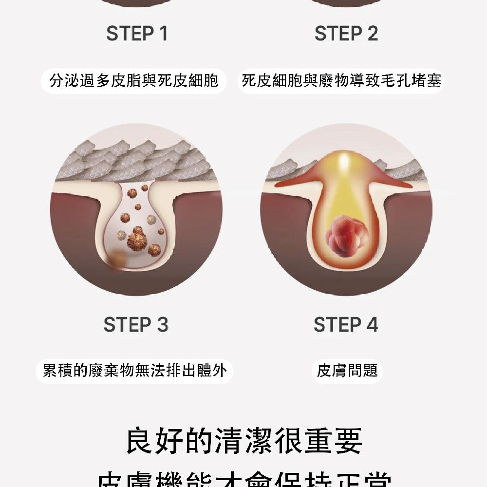 STEP 1STEP 2分泌過多皮脂與死皮細胞 死皮細胞與廢物導致毛孔堵塞STEP 3STEP 4累積的廢棄物無法排出體外問題良好的清潔很重要皮膚正