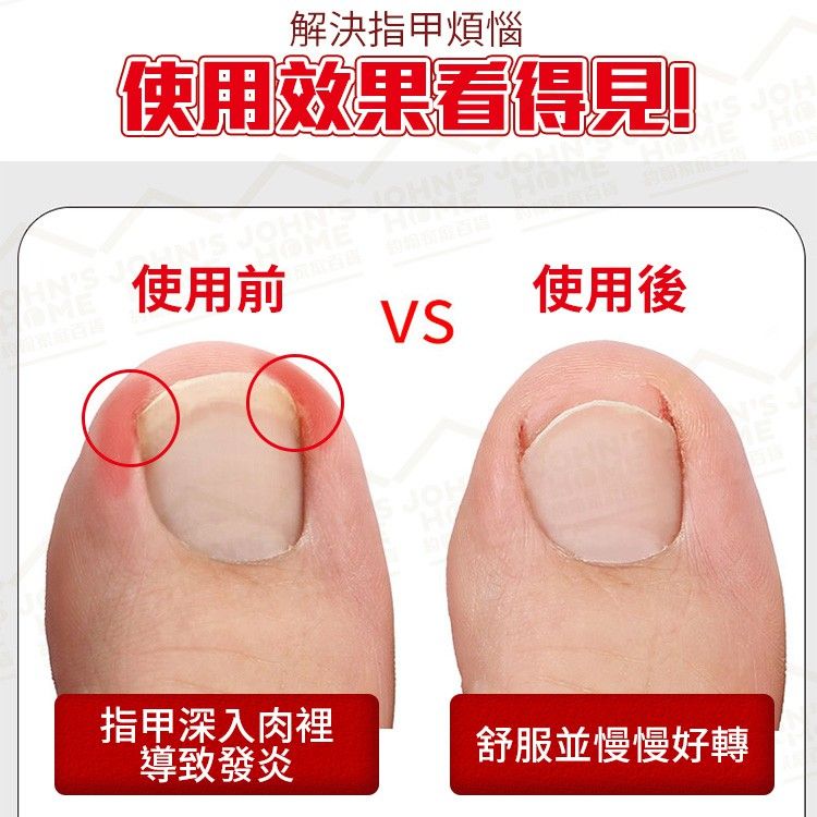  黑刃甲溝不鏽鋼鷹嘴鉗 3件套 附剃甲器與銼刀 指甲剪 甲溝鉗 嵌甲剪