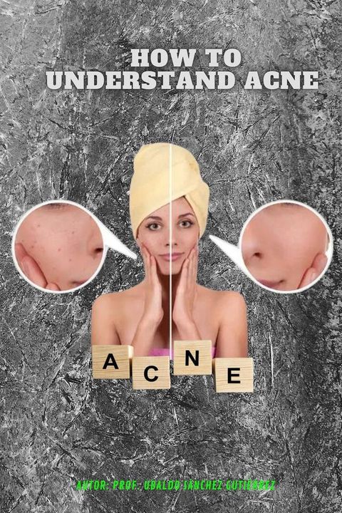 Understanding acne(Kobo/電子書)