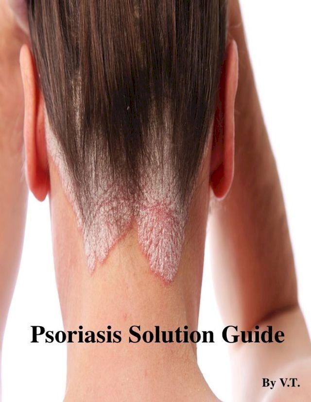  Psoriasis Solution Guide(Kobo/電子書)