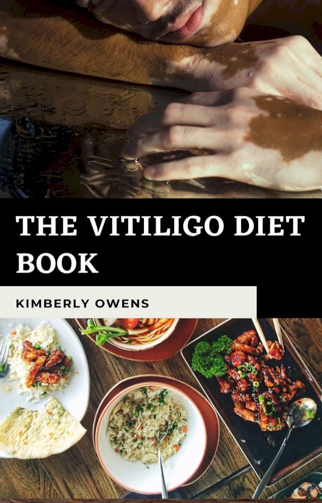  The Vitiligo Diet Book(Kobo/電子書)