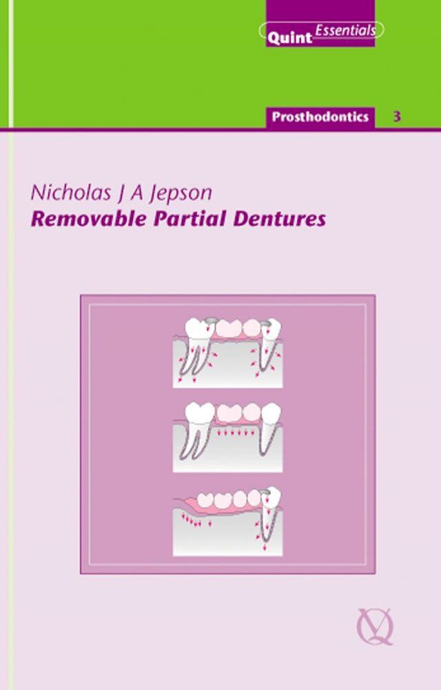  Removable Partial Dentures(Kobo/電子書)