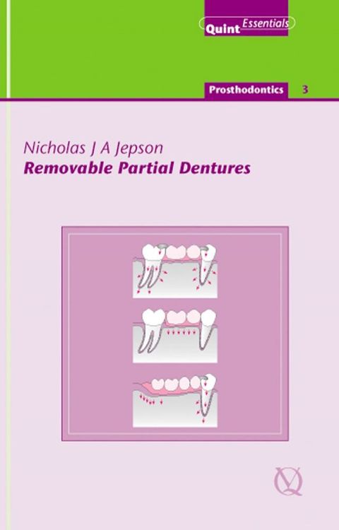 Removable Partial Dentures(Kobo/電子書)