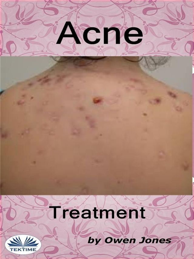  Acne Treatment(Kobo/電子書)