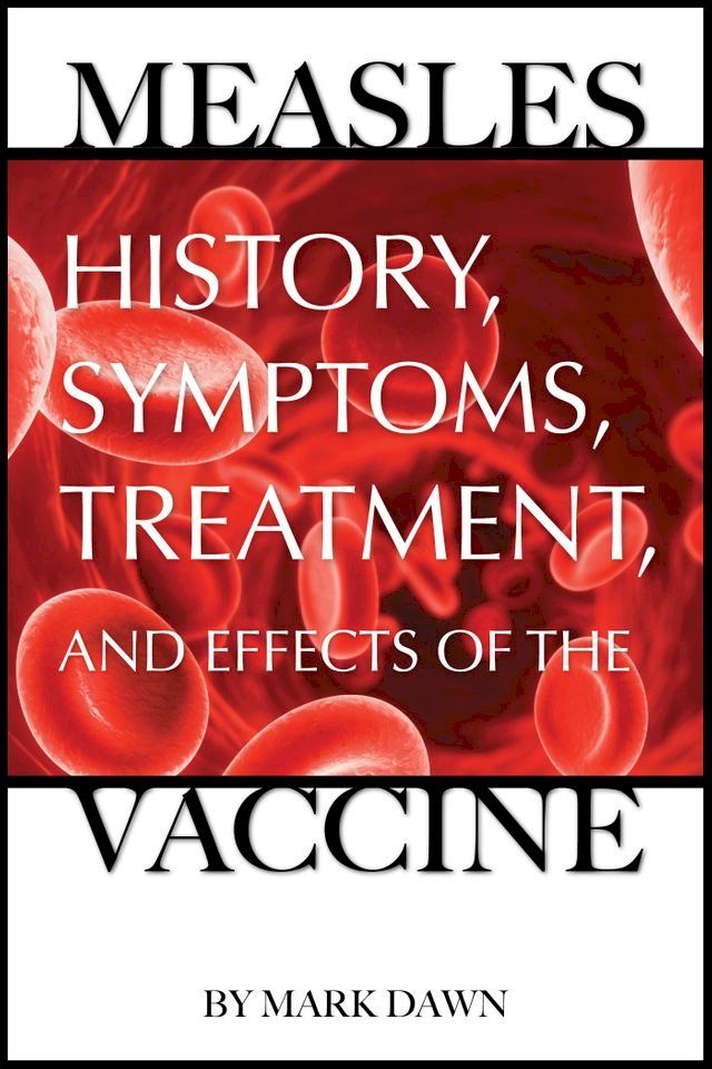  Measles: History, Symptoms, Treatment, and Effects of the Vaccine(Kobo/電子書)