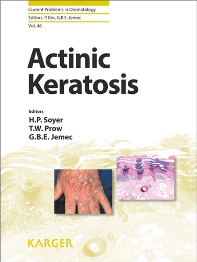  Actinic Keratosis(Kobo/電子書)