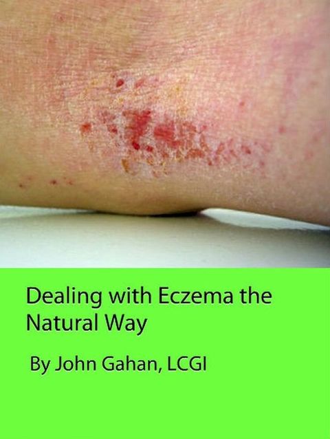 Dealing with Eczema the Natural Way(Kobo/電子書)