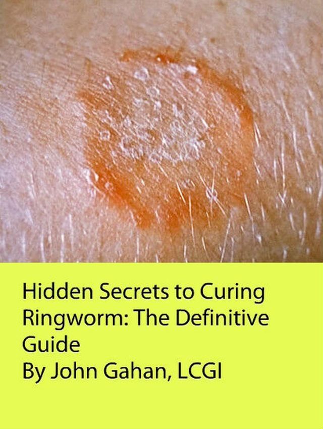  Hidden Secrets to Curing Ringworm: The Definitive Guide(Kobo/電子書)