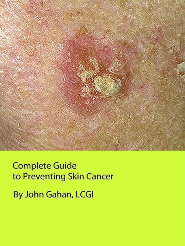  Complete Guide to Preventing Skin Cancer(Kobo/電子書)