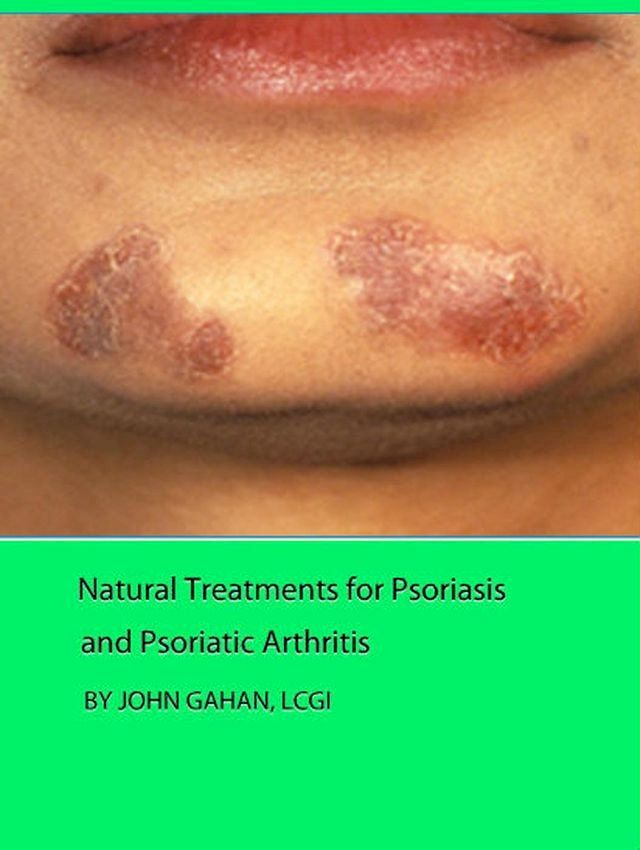  Natural Treatments for Psoriasis and Psoriatic Arthritis(Kobo/電子書)