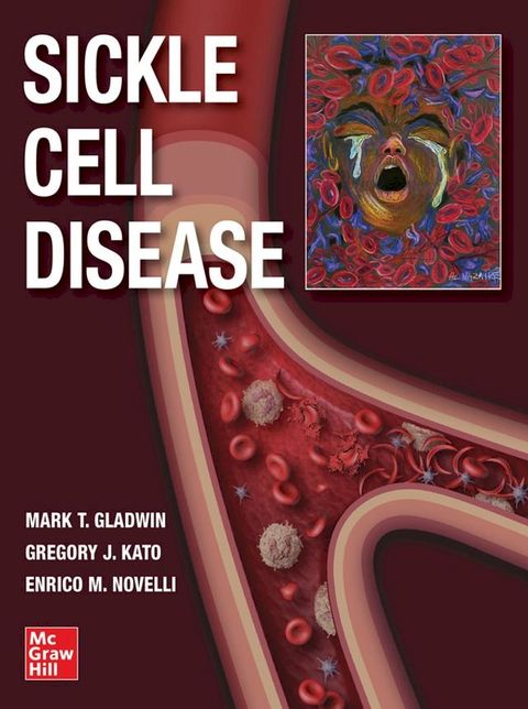 Sickle Cell Disease(Kobo/電子書)