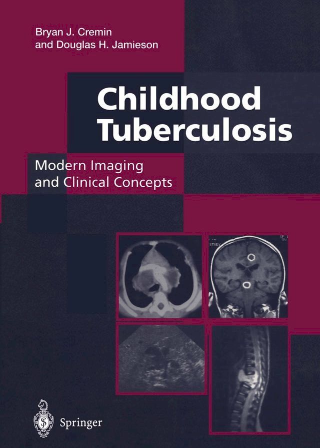  Childhood Tuberculosis: Modern Imaging and Clinical Concepts(Kobo/電子書)