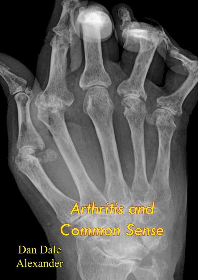  Arthritis and Common Sense(Kobo/電子書)