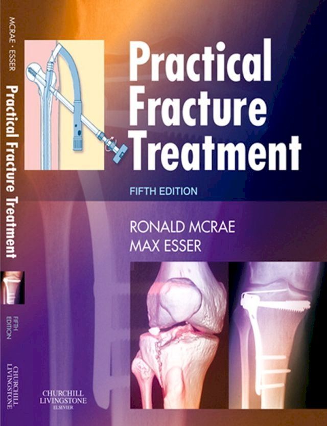  Practical Fracture Treatment E-Book(Kobo/電子書)