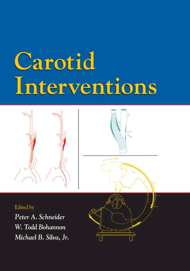  Carotid Interventions(Kobo/電子書)