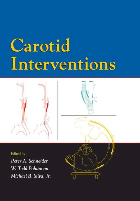 Carotid Interventions(Kobo/電子書)