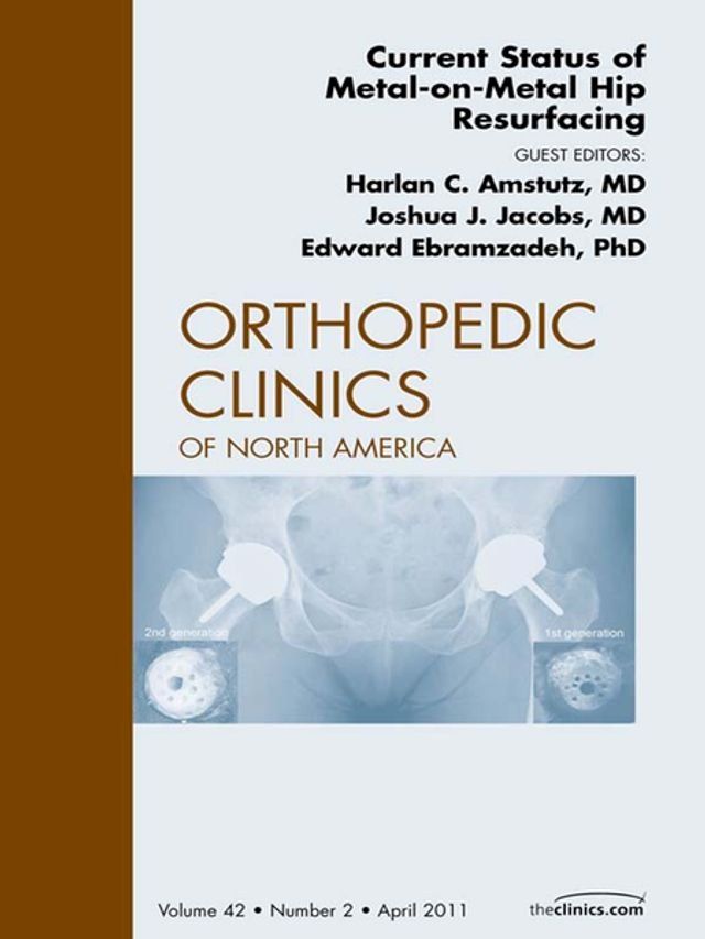  Current Status of Metal-on-Metal Hip Resurfacing, An Issue of Orthopedic Clinics(Kobo/電子書)