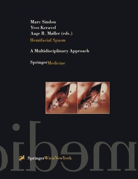 Hemifacial Spasm(Kobo/電子書)