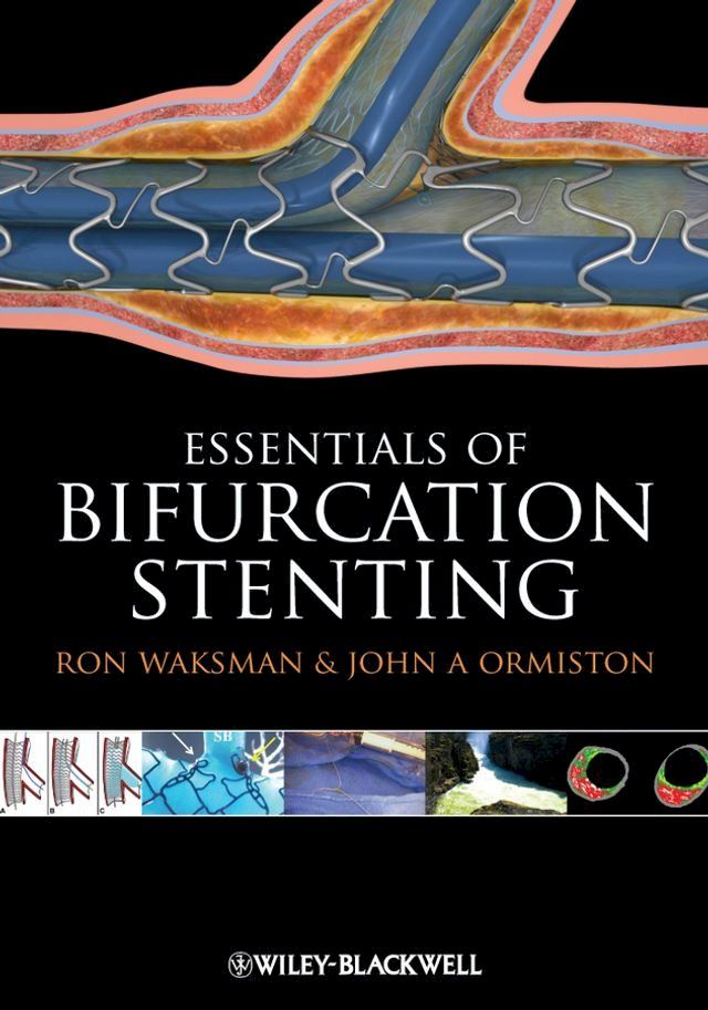  Bifurcation Stenting(Kobo/電子書)