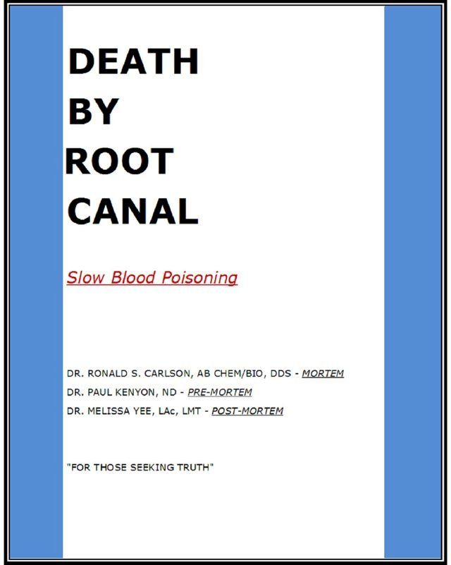  Death By Root Canal(Kobo/電子書)