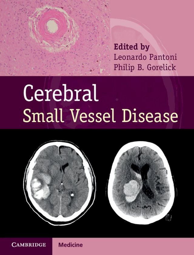  Cerebral Small Vessel Disease(Kobo/電子書)