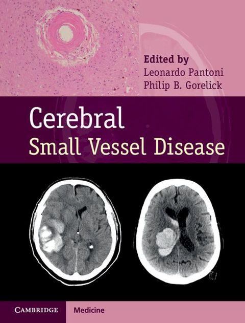 Cerebral Small Vessel Disease(Kobo/電子書)