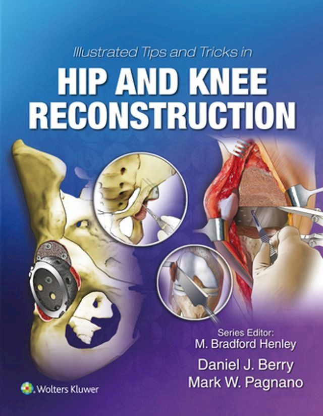  Illustrated Tips and Tricks in Hip and Knee Reconstructive and Replacement Surgery(Kobo/電子書)