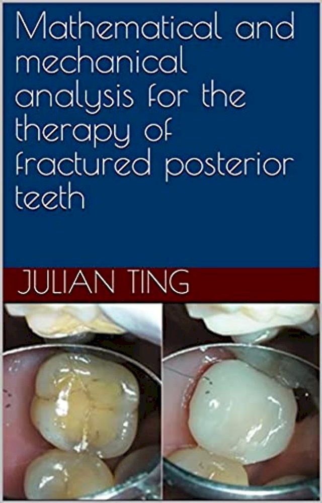  Mathematical and mechanical analysis for the therapy of fractured posterior teeth(Kobo/電子書)