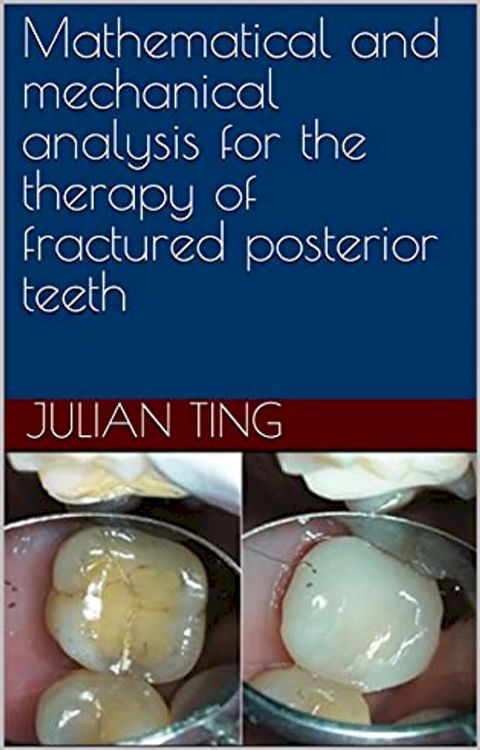 Mathematical and mechanical analysis for the therapy of fractured posterior teeth(Kobo/電子書)