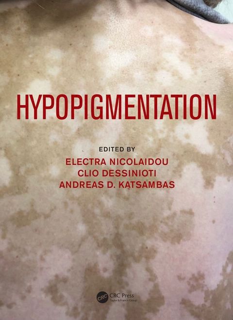 Hypopigmentation(Kobo/電子書)