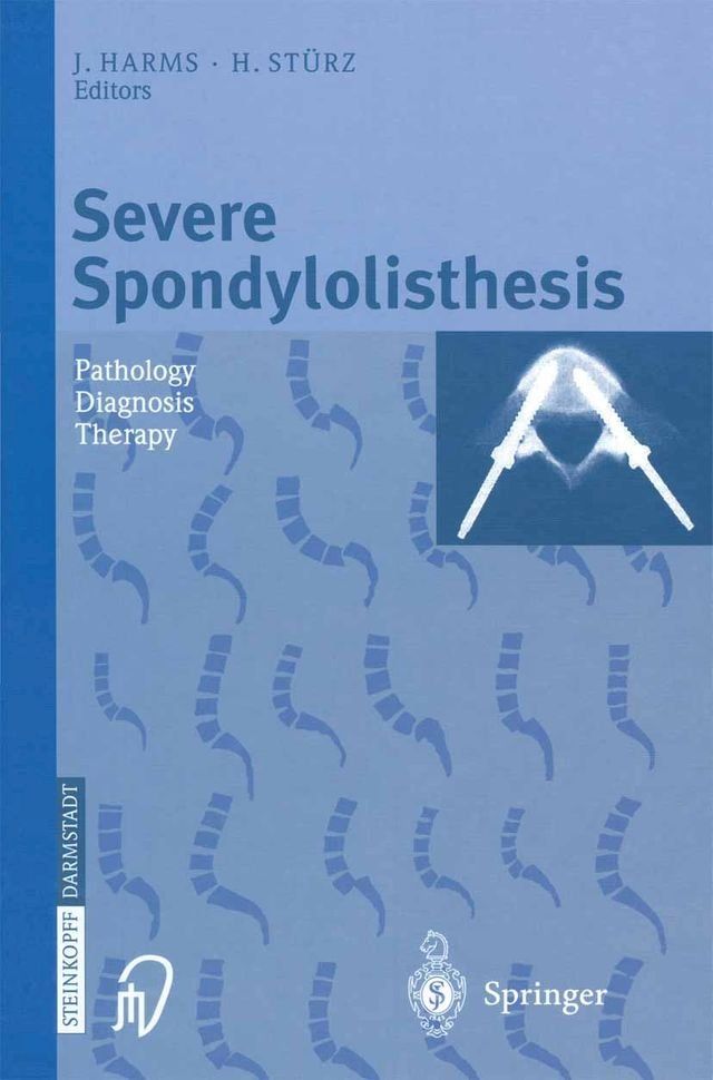  Severe Spondylolisthesis(Kobo/電子書)