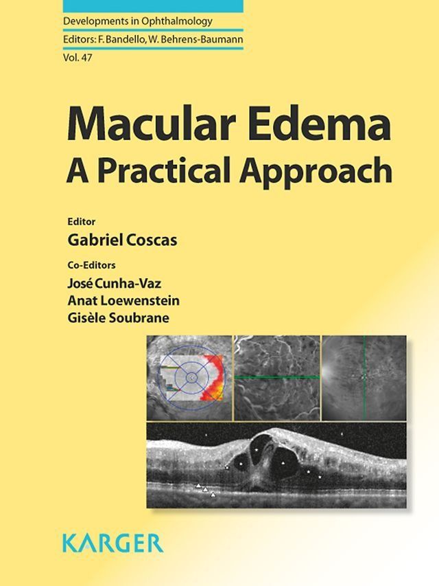  Macular Edema(Kobo/電子書)