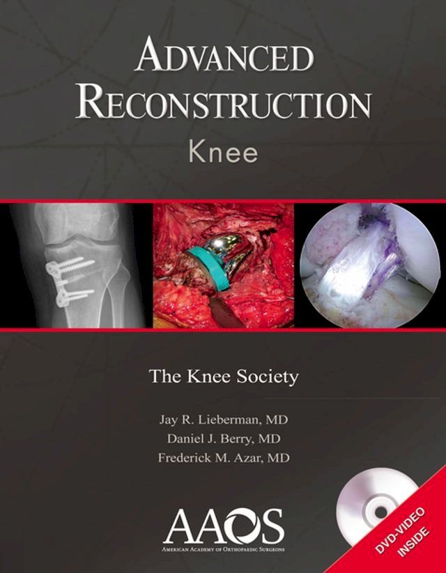  Advanced Reconstruction: Knee(Kobo/電子書)