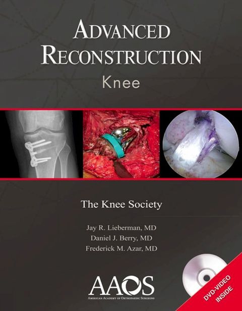 Advanced Reconstruction: Knee(Kobo/電子書)