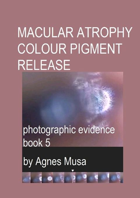 Macular Atrophy Colour Pigment Release, Photographic Evidence Book 5(Kobo/電子書)