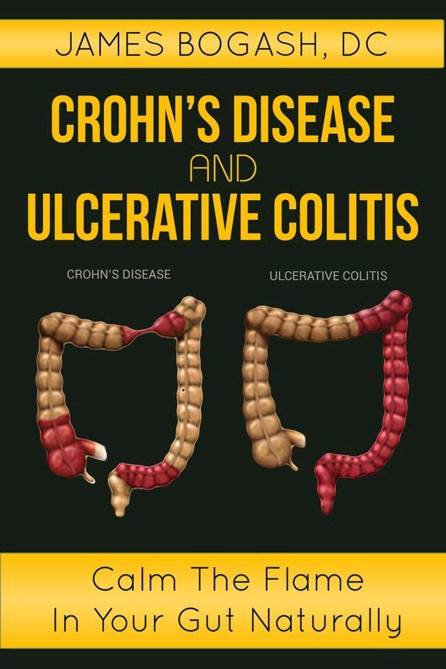  Crohn's Disease and Ulcerative Colitis: Calm the Flame in Your Gut Naturally(Kobo/電子書)