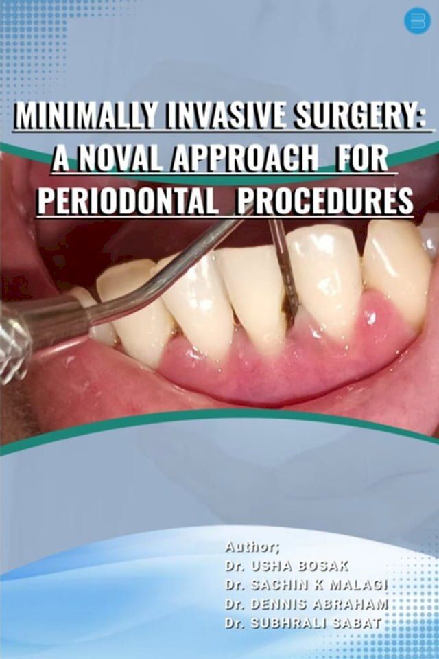  MINIMALLY INVASIVE SURGERY : A NOVEL APPROACH FOR PERIODONTAL PROCEDURES(Kobo/電子書)