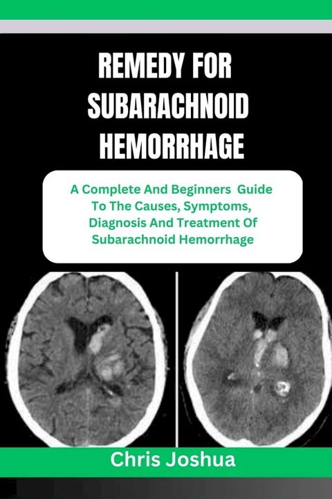 REMEDY FOR SUBARACHNOID HEMORRHAGE(Kobo/電子書)