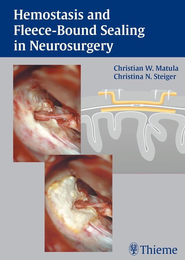  Hemostasis and Fleece-Bound Sealing in Neurosurgery(Kobo/電子書)