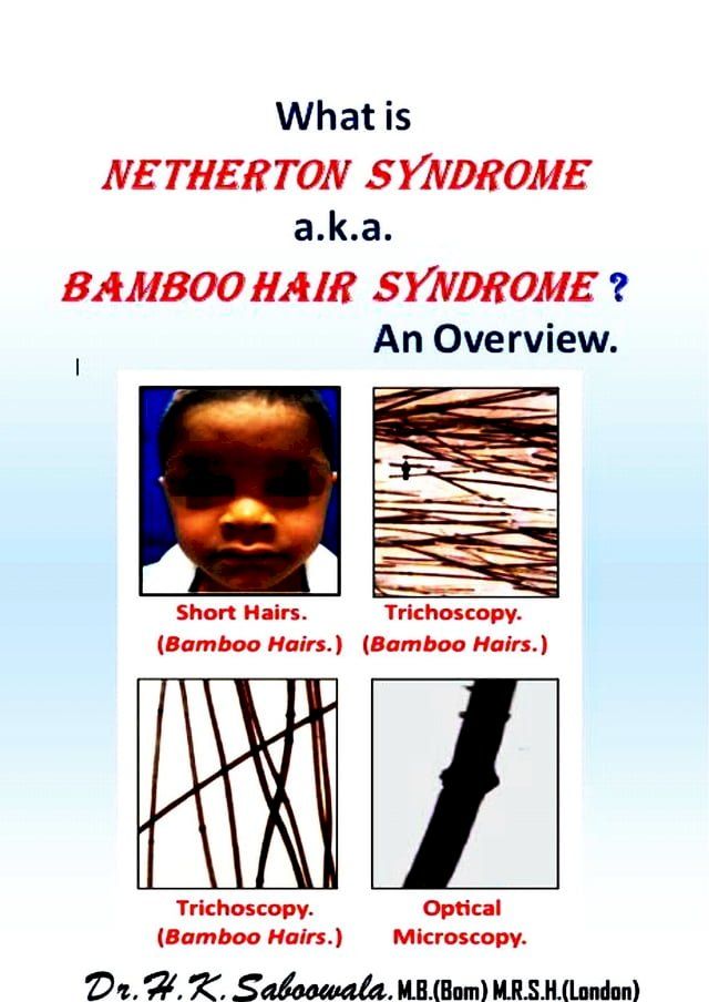  What is Netherton Syndrome a.k.a. Bamboo Hair Syndrome(Kobo/電子書)