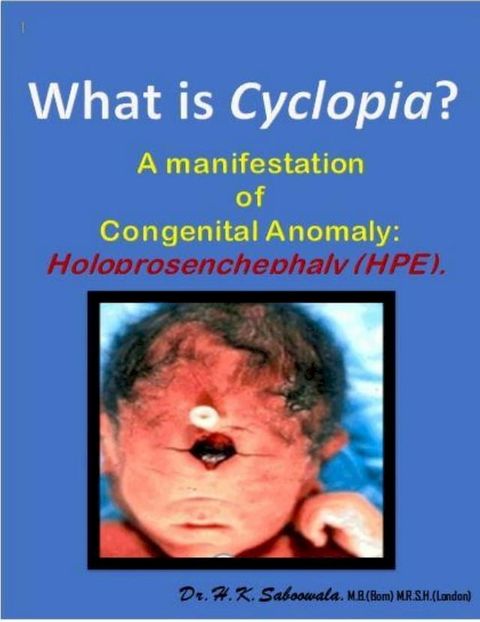 What is Cyclopia ? A manifestation of Congenital Anomaly: Holoprosenchephaly (HPE)(Kobo/電子書)