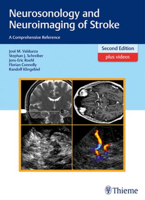 Neurosonology and Neuroimaging of Stroke(Kobo/電子書)