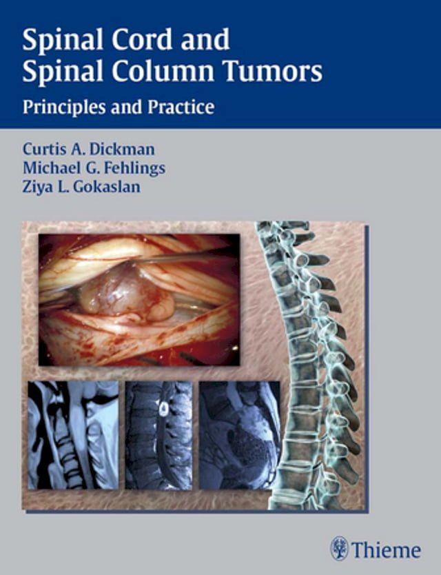  Spinal Cord and Spinal Column Tumors(Kobo/電子書)