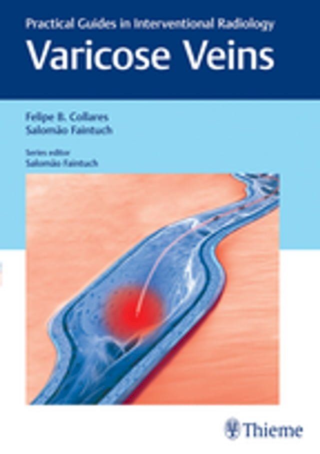  Varicose Veins(Kobo/電子書)