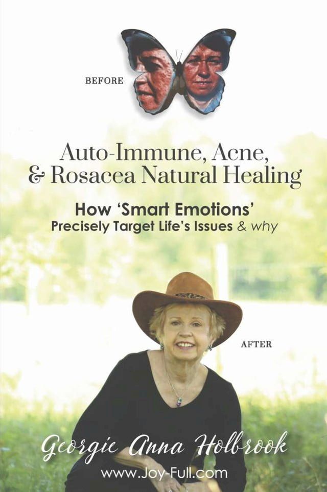  Auto-Immune, Acne, & Rosacea Natural Healing - How 'Smart Emotions' Precisely Target Life's Issues & Why(Kobo/電子書)