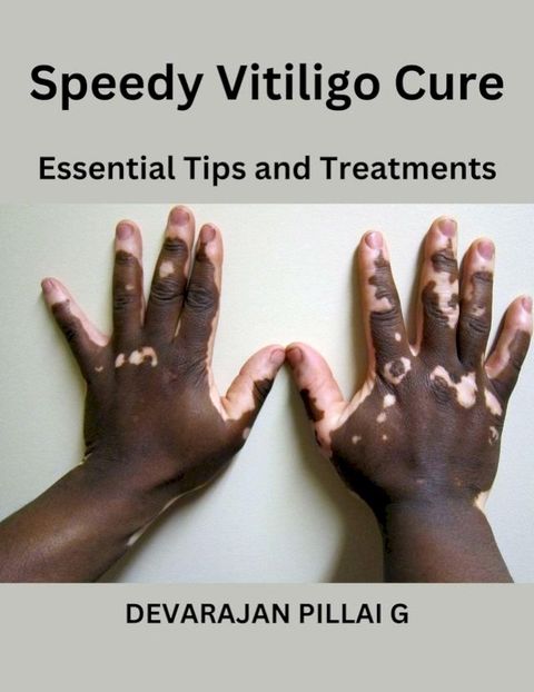 Speedy Vitiligo Cure: Essential Tips and Treatments(Kobo/電子書)