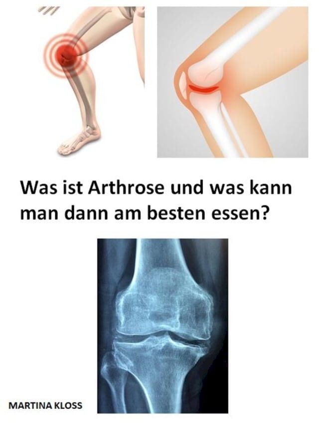  Was ist Arthrose und was kann man dann am besten essen?(Kobo/電子書)